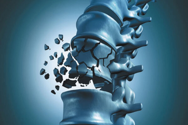 پوک شدن استخوان یک زن ایرانی از هر ۲ نفر مهم‌ترین عوامل بروز پوکی استخوان در میانسالی لزوم مصرف ۲ ماده مهم برای پیشگیری از پوکی استخوان