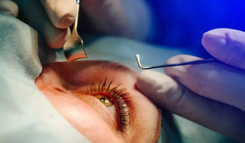 شیوع قوز قرنیه در ایران بالاتر از جهان