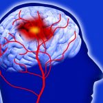 علائم هشدار دهنده سکته مغزی فقط 6 ساعت برای نجات فرصت دارید