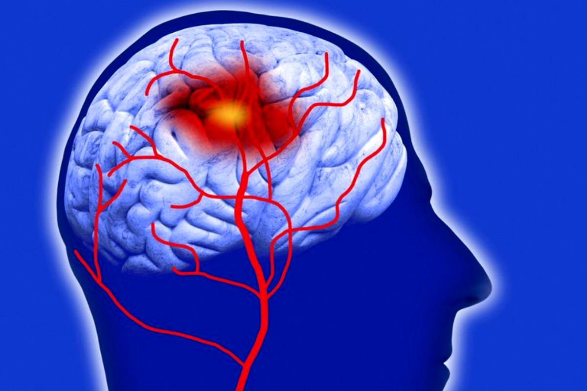 Read more about the article علائم سکته مغزی را جدی بگیرید فقط ۶ ساعت برای نجات بیمار فرصت است